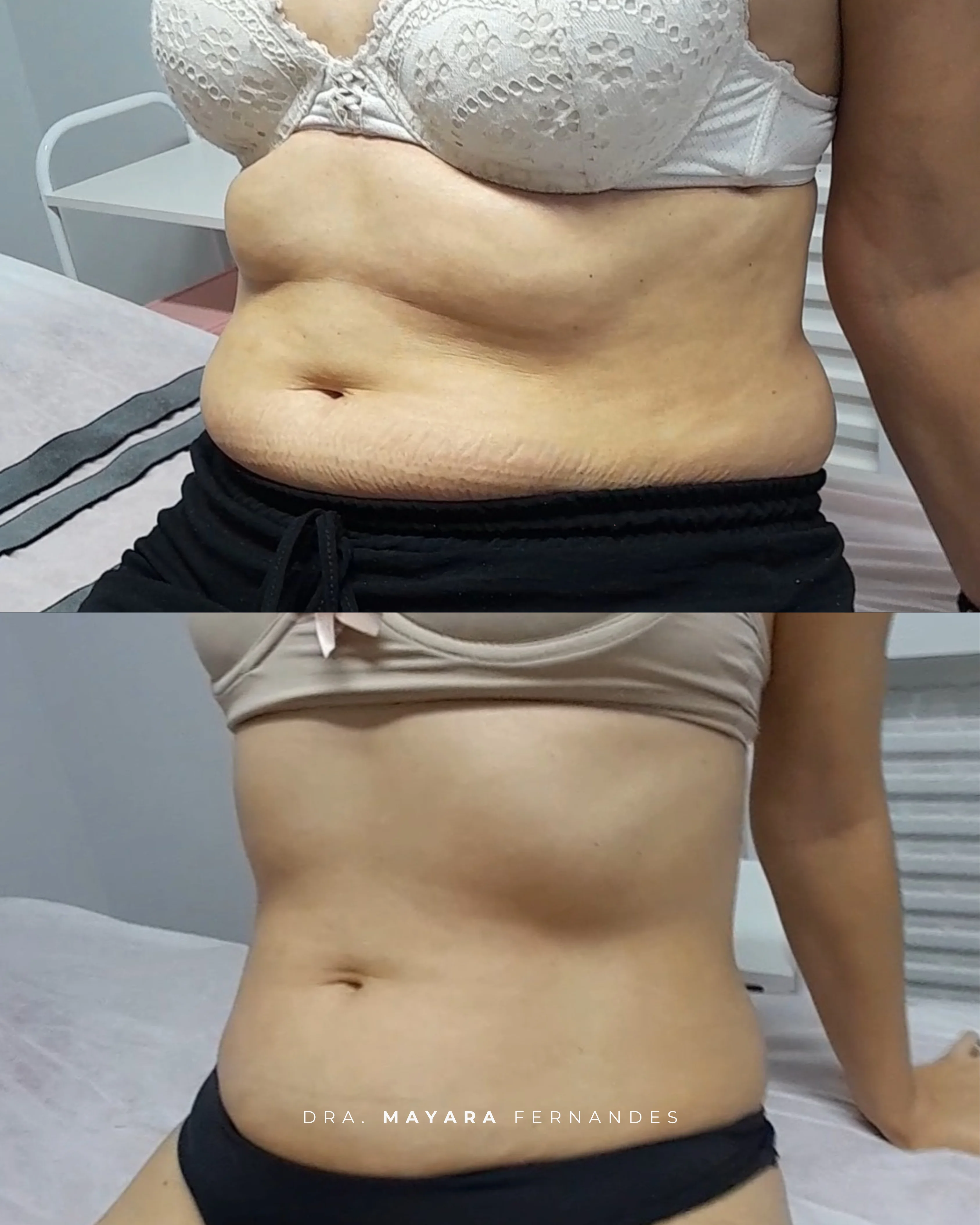 Resultado CrioShape Moriah