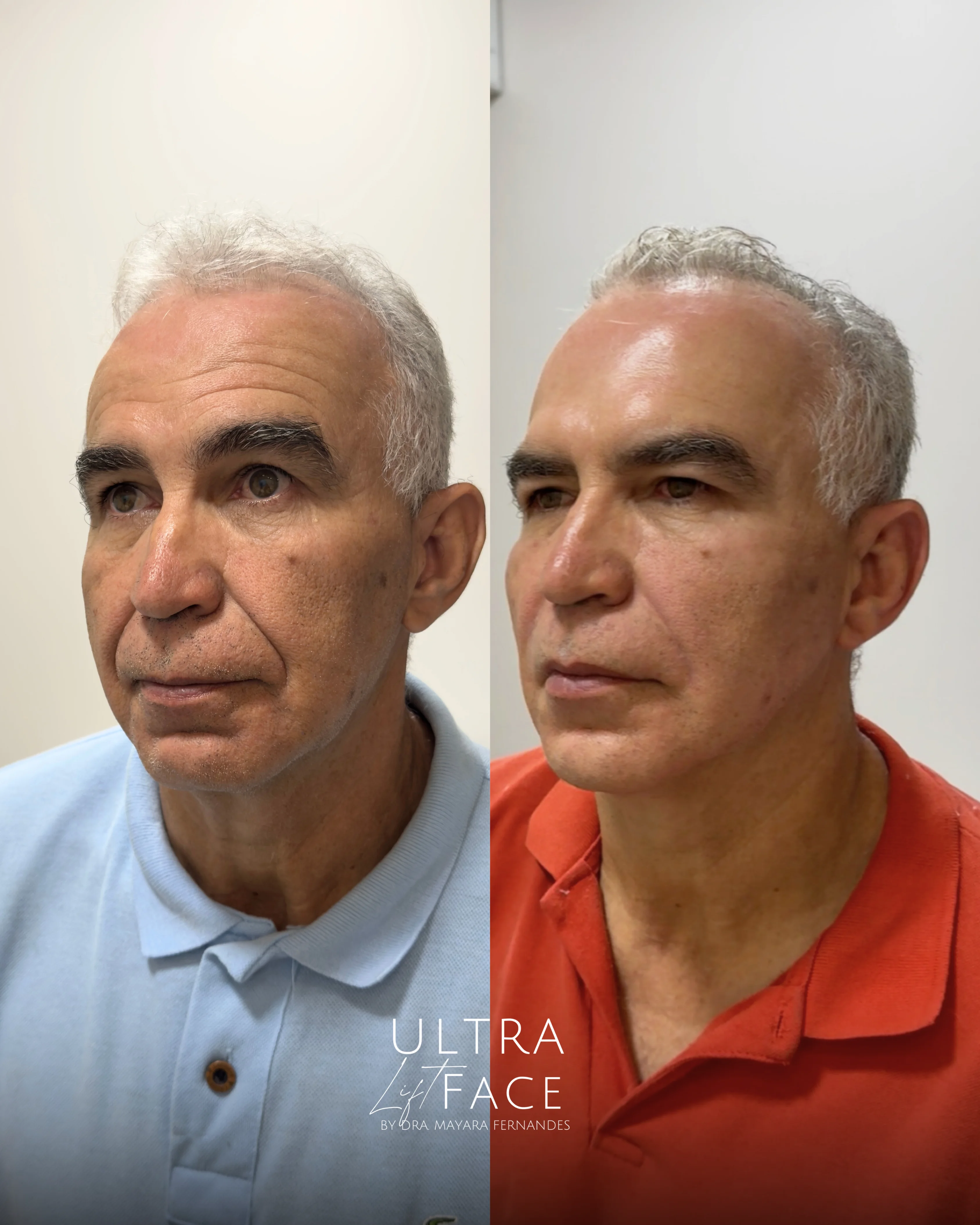 Resultado Harmonização Facial