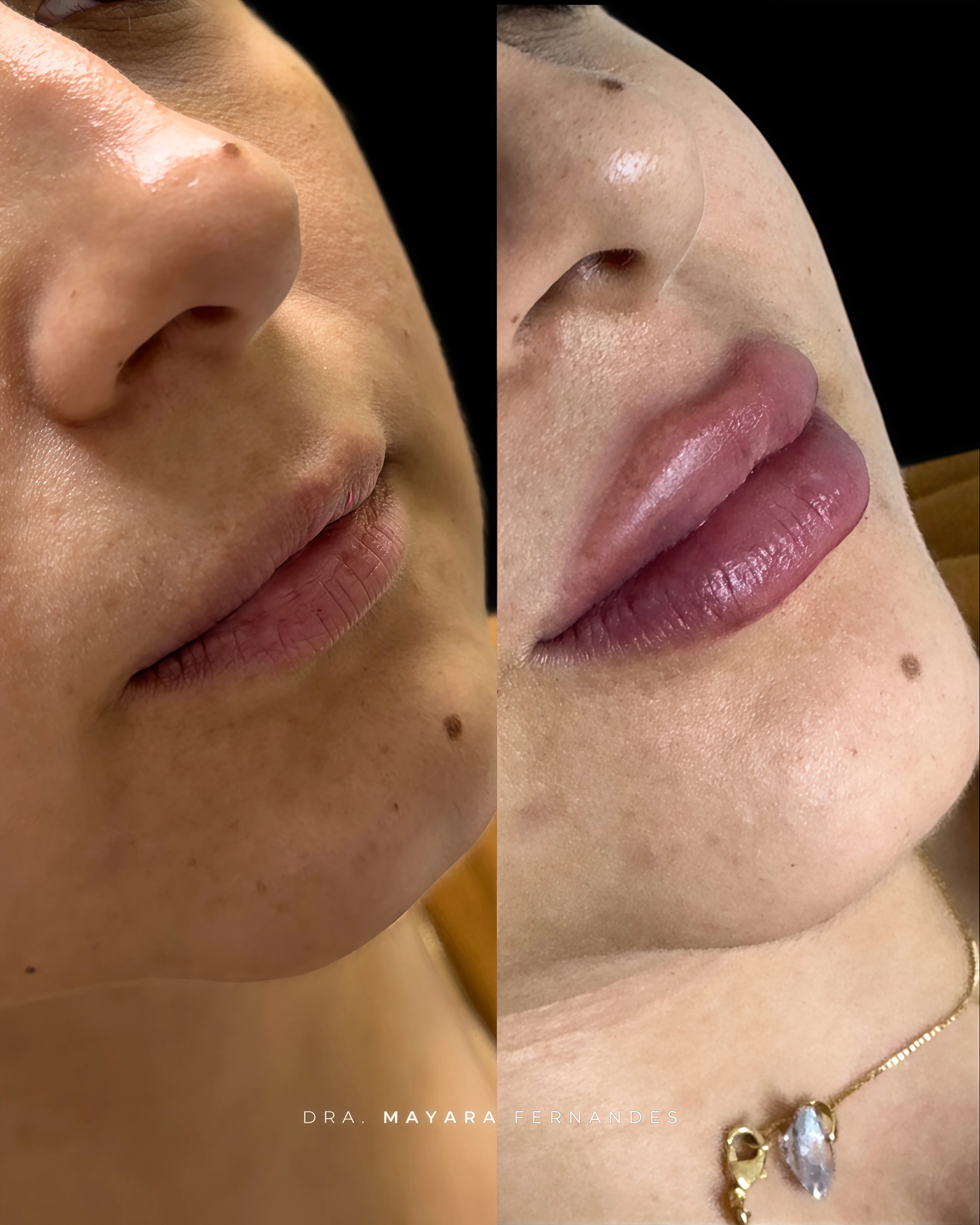 Resultado Preenchimento Labial