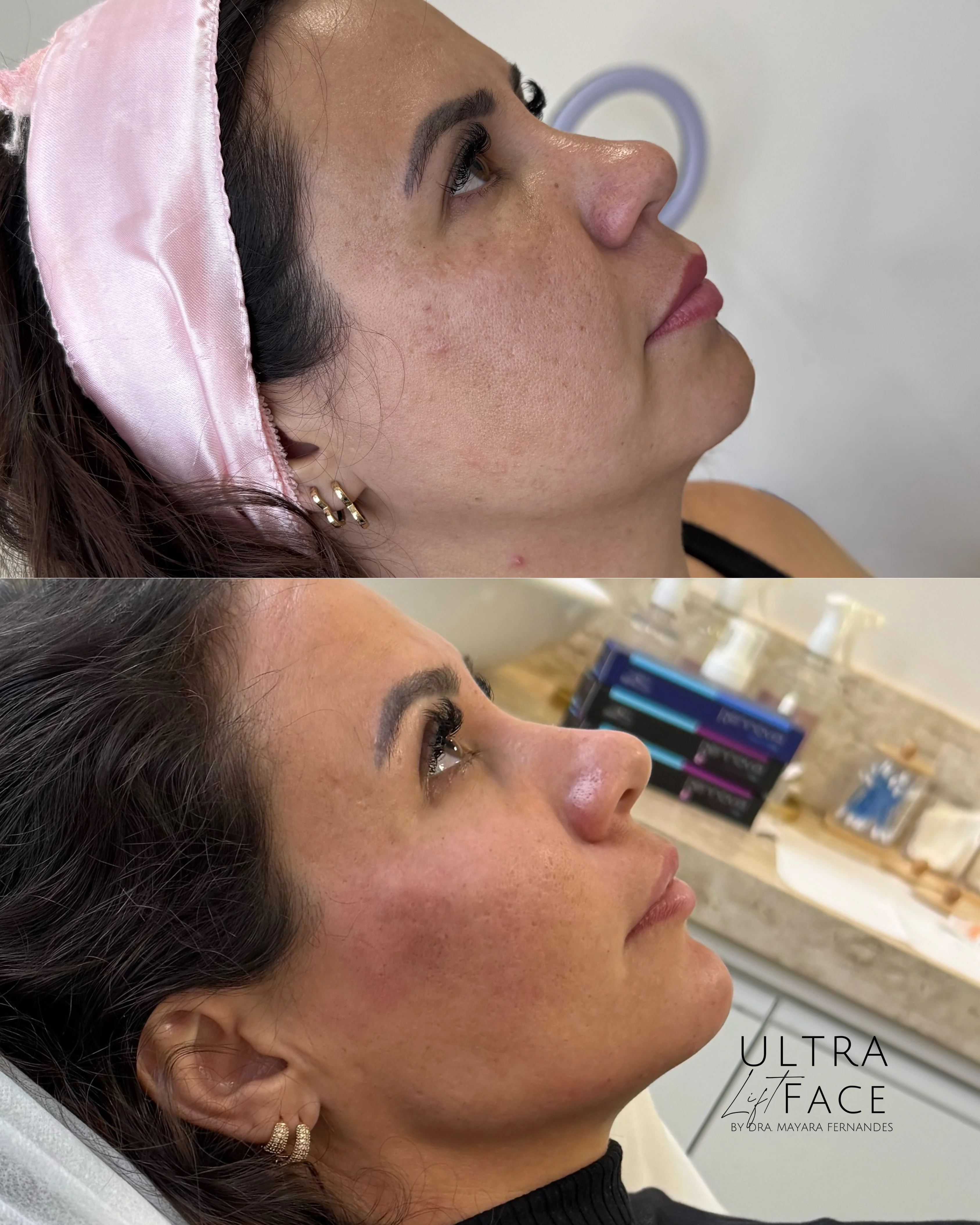 Resultado Perfiloplastia