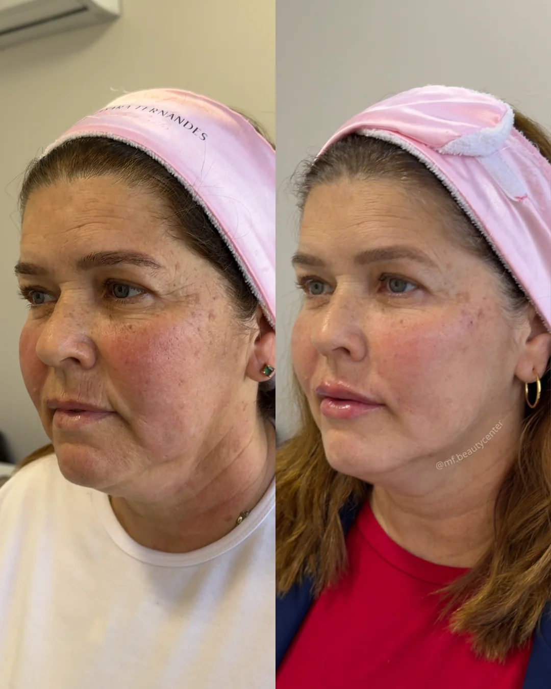 Resultado Ultra Face Lift