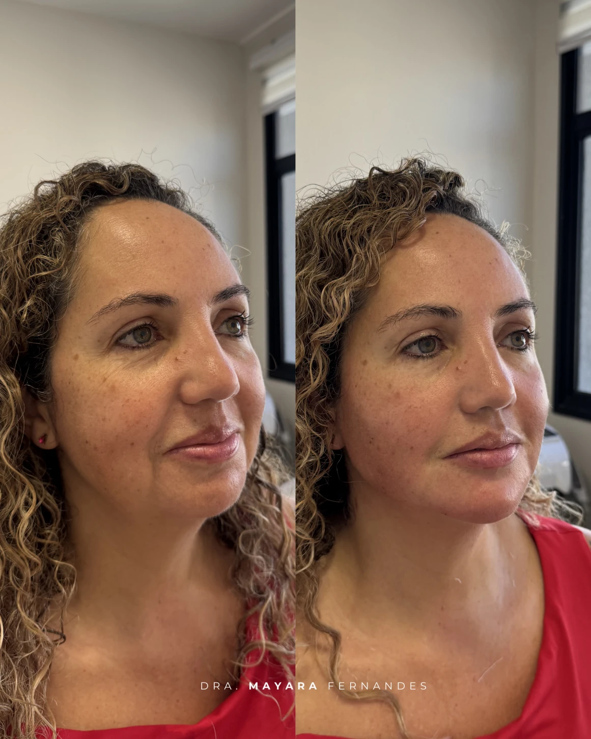 Resultado Ultraface Lift